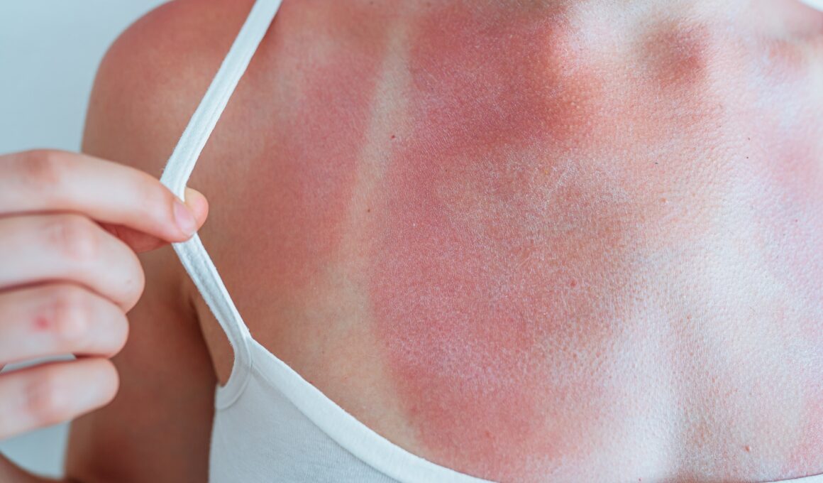Swimsuit strap marks on young woman's sunburned skin